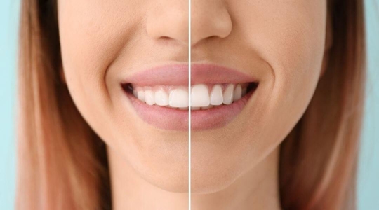 before and after of a gummy smile