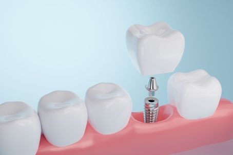 dental implants digital rendering